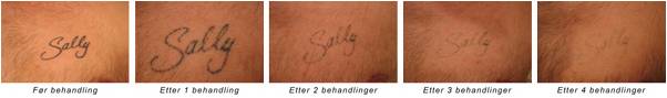 Tatoveringen blekkpartiklene behandlingen bivirkninger bilde 1