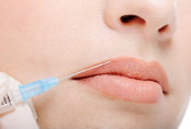 Restylane bruksomrader smilerynker roykerynker bilde 2